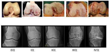 胫骨高位截骨手术视频