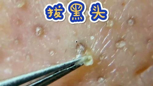 拔黑头粉刺视频